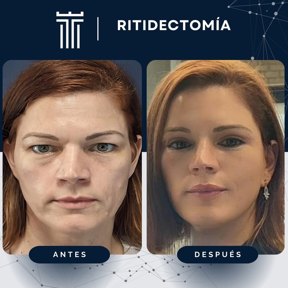 Before and After Result